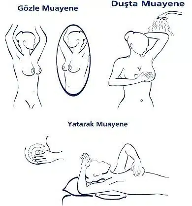 Meme Kanseri Meme Kanseri